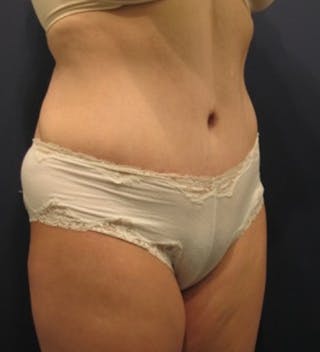 Tummy Tuck Before & After Gallery - Patient 174178662 - Image 6
