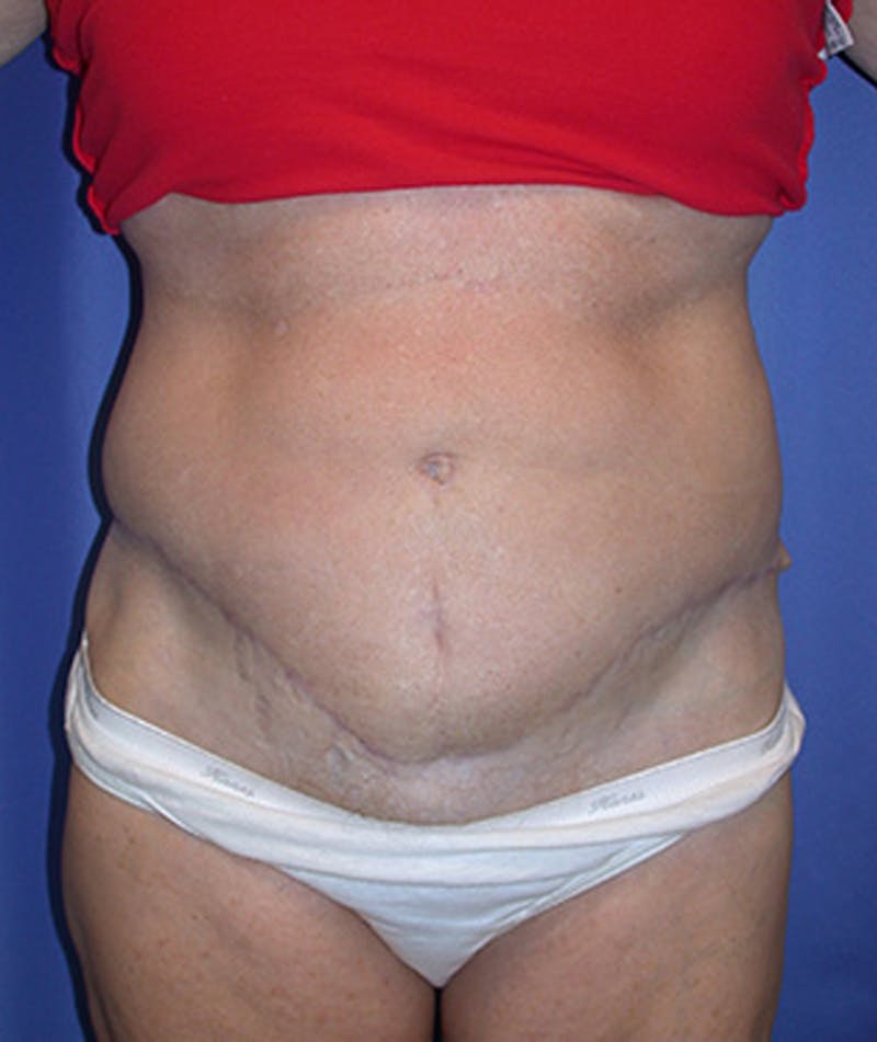 Tummy Tuck Before & After Gallery - Patient 174178663 - Image 1