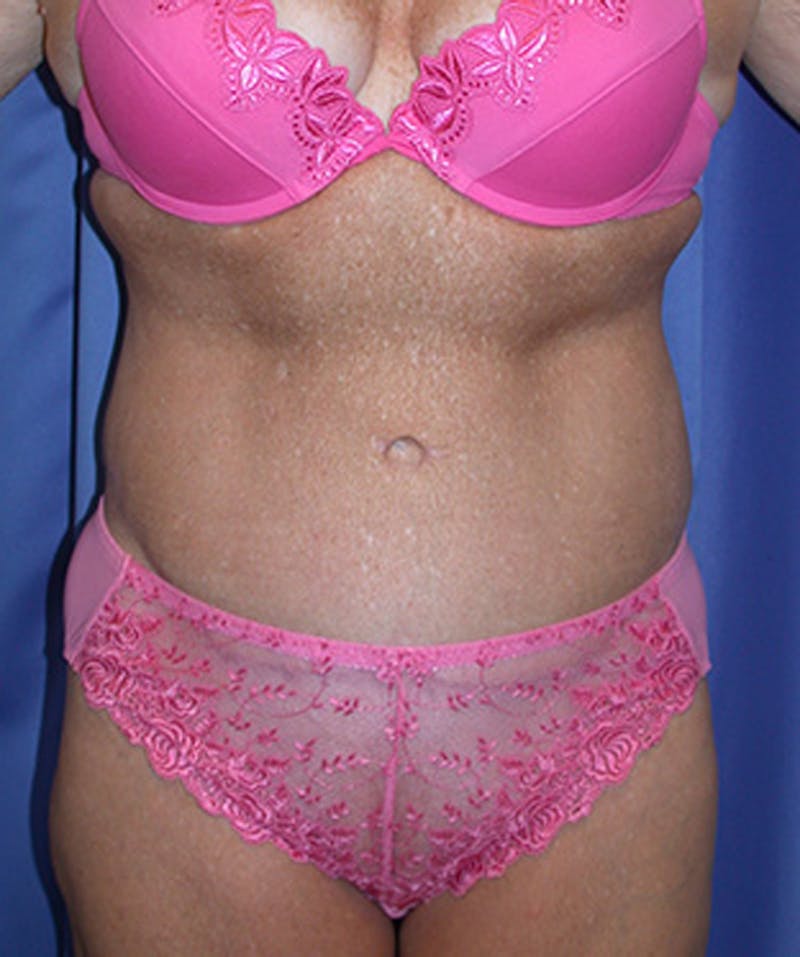Tummy Tuck Before & After Gallery - Patient 174178663 - Image 2