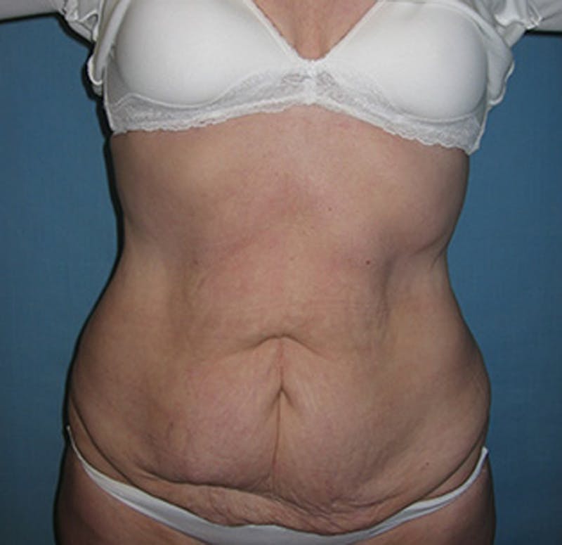 Tummy Tuck Before & After Gallery - Patient 174178665 - Image 1
