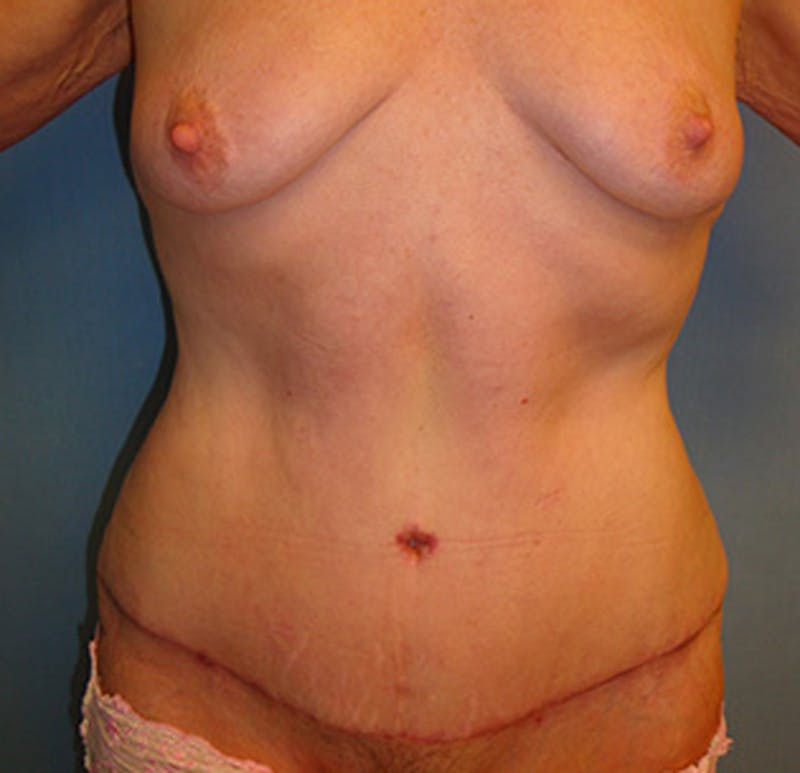 Tummy Tuck Before & After Gallery - Patient 174178665 - Image 2