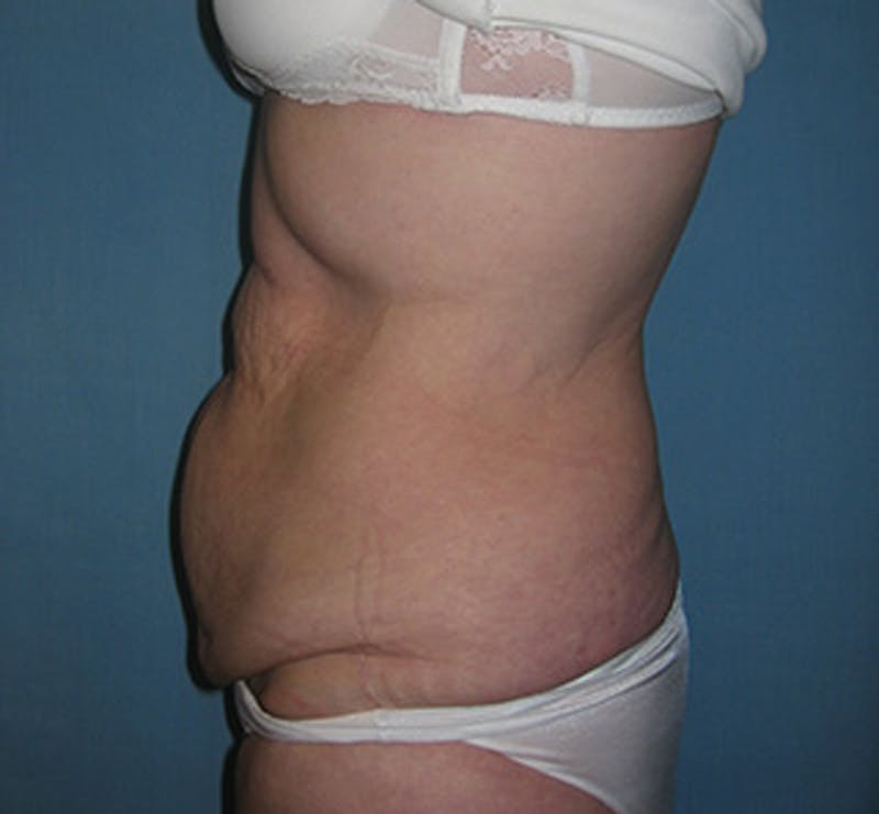 Tummy Tuck Before & After Gallery - Patient 174178665 - Image 3