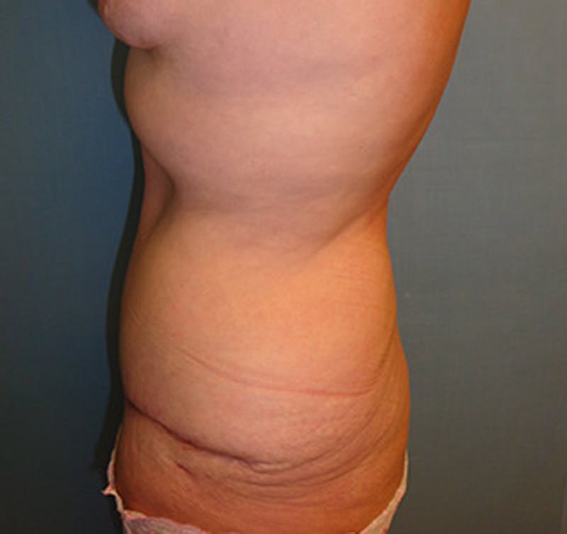 Tummy Tuck Before & After Gallery - Patient 174178665 - Image 4