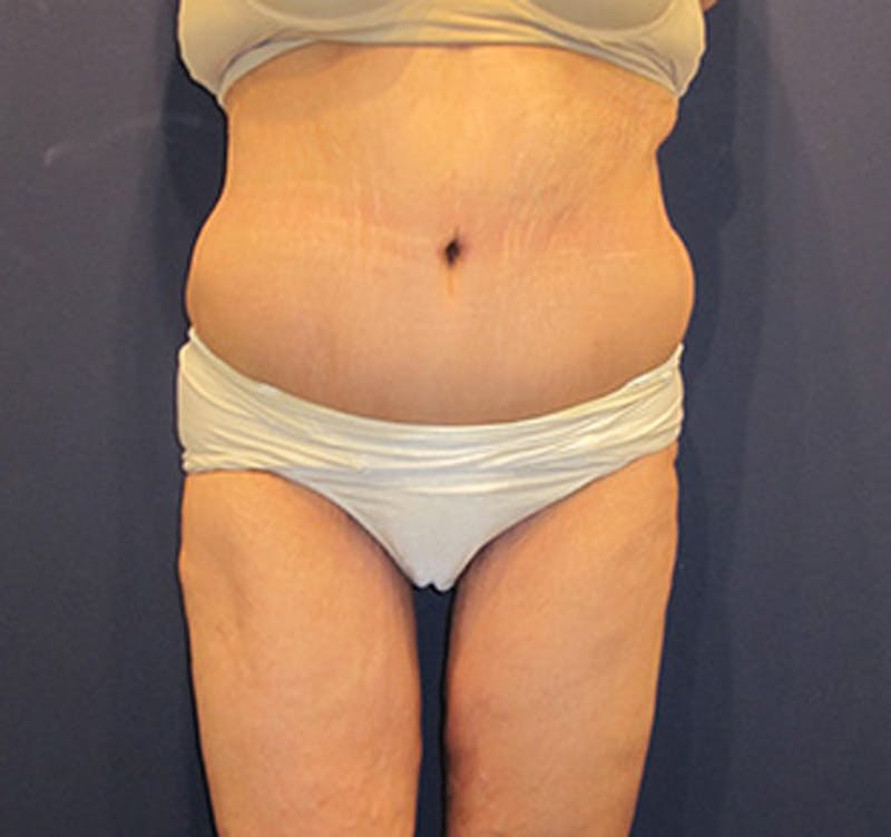 Tummy Tuck Before & After Gallery - Patient 174178666 - Image 2