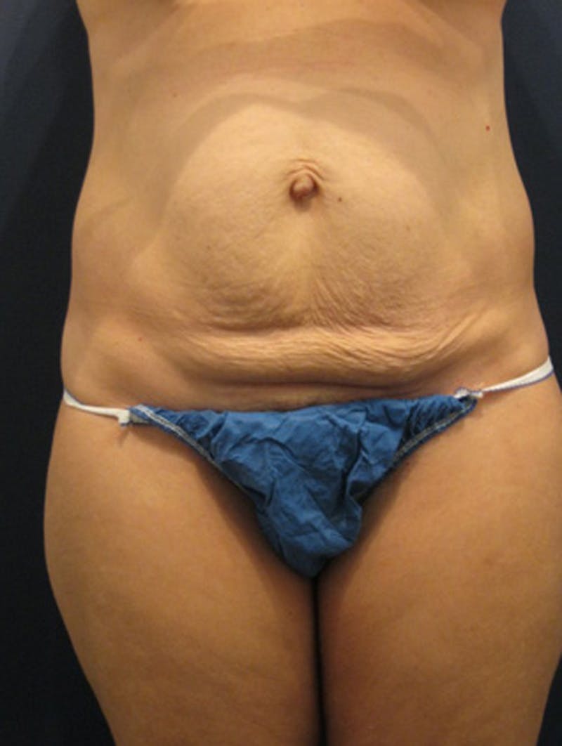 Tummy Tuck Before & After Gallery - Patient 174178668 - Image 1