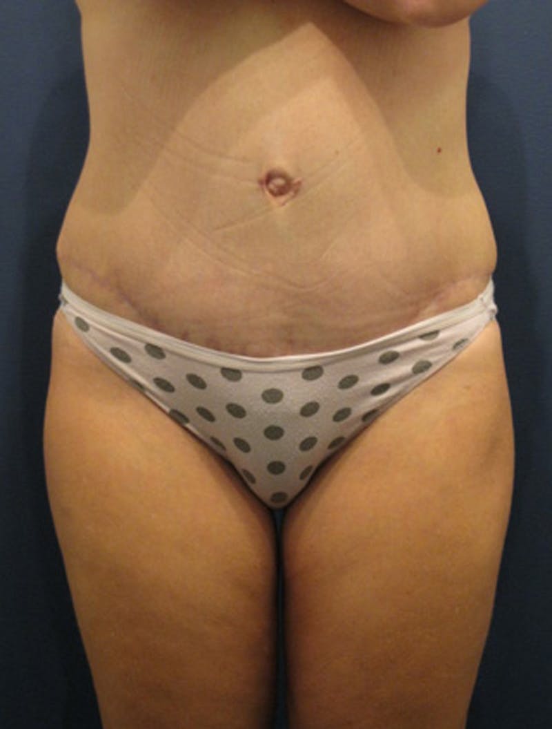 Tummy Tuck Before & After Gallery - Patient 174178668 - Image 2
