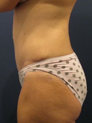 Tummy Tuck Before & After Gallery - Patient 174178668 - Image 4