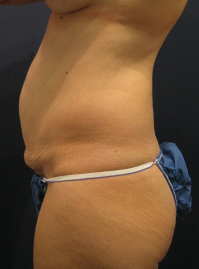 Tummy Tuck Before & After Gallery - Patient 174178668 - Image 3