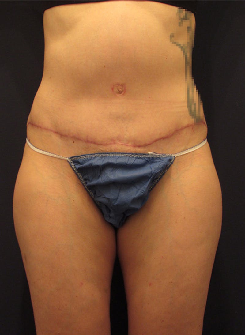 Tummy Tuck Before & After Gallery - Patient 174179741 - Image 2
