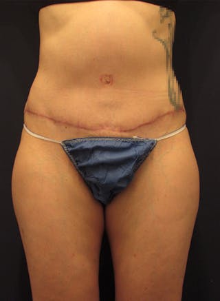 Tummy Tuck Before & After Gallery - Patient 174179741 - Image 2