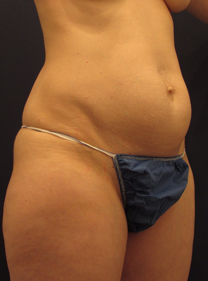 Tummy Tuck Before & After Gallery - Patient 174179741 - Image 3