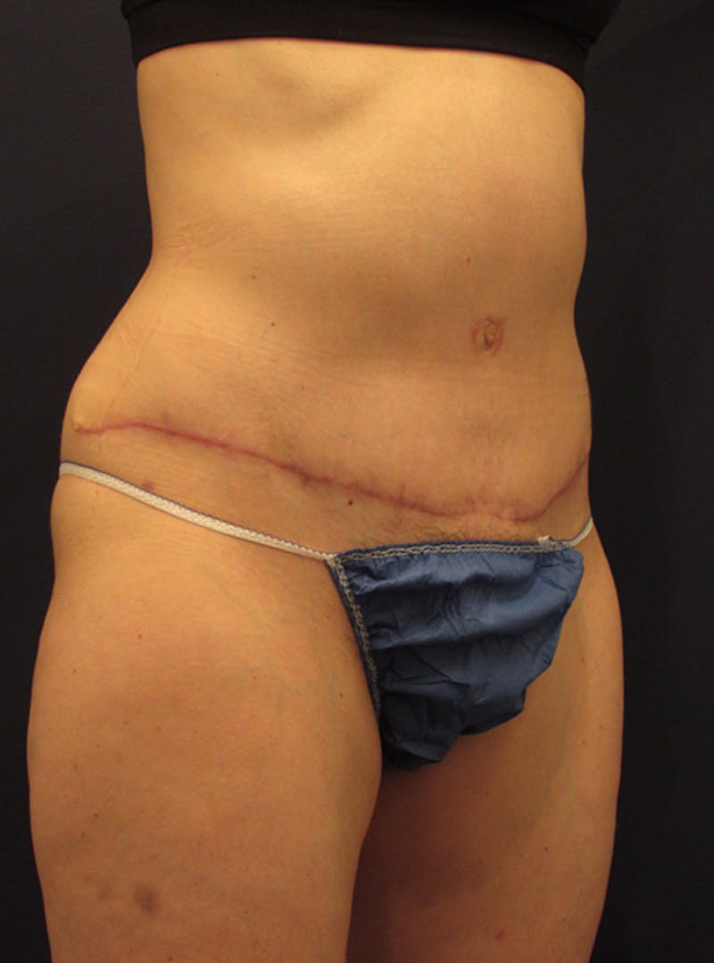 Tummy Tuck Before & After Gallery - Patient 174179741 - Image 4