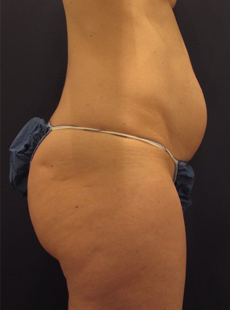 Tummy Tuck Before & After Gallery - Patient 174179741 - Image 5