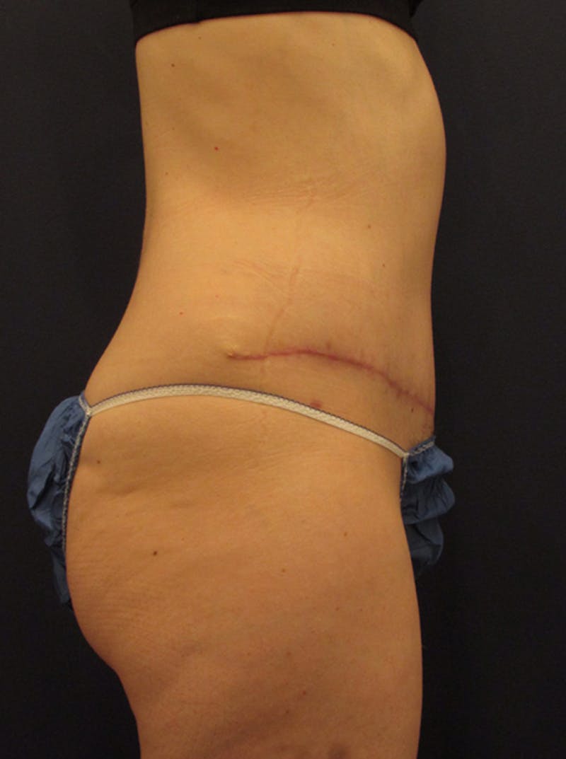 Tummy Tuck Before & After Gallery - Patient 174179741 - Image 6