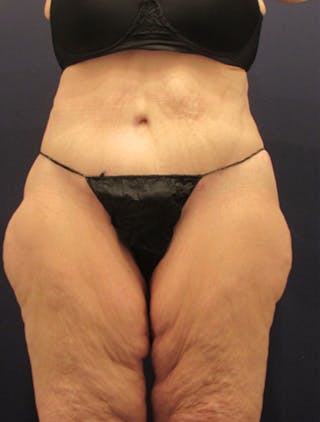 Tummy Tuck Before & After Gallery - Patient 174179744 - Image 2