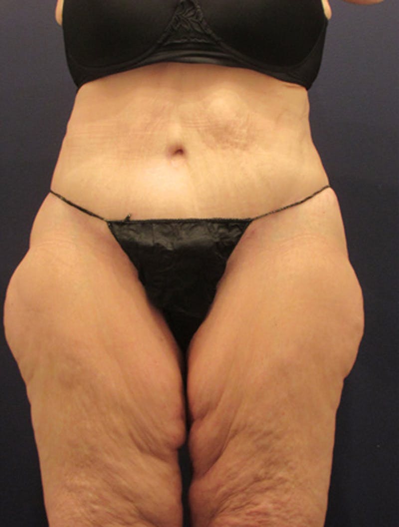 Tummy Tuck Before & After Gallery - Patient 174179744 - Image 2