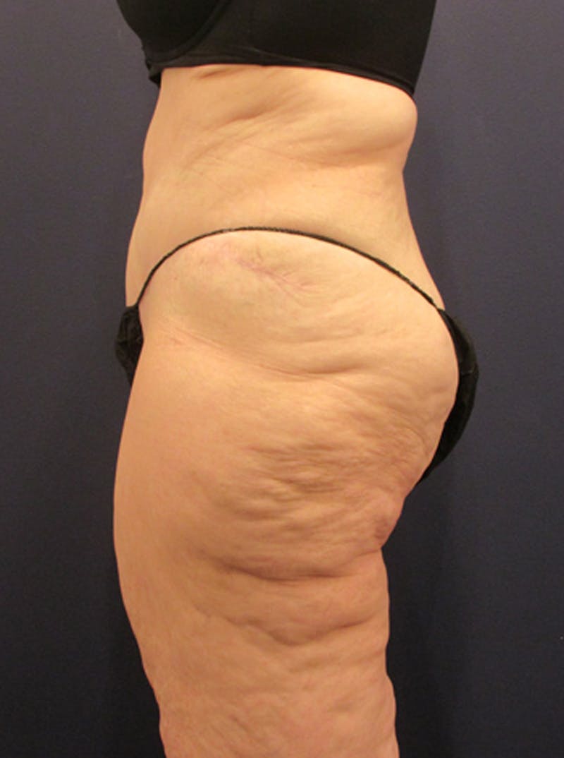Tummy Tuck Before & After Gallery - Patient 174179744 - Image 6