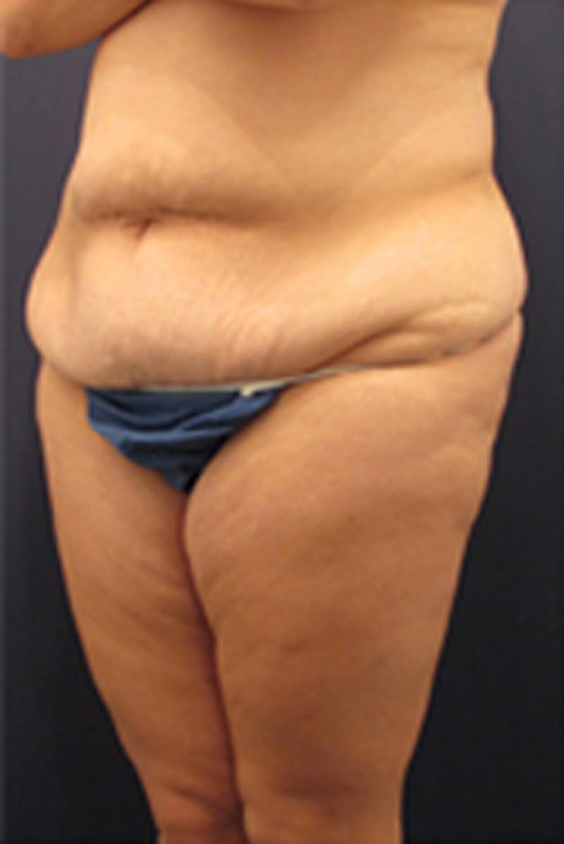 Tummy Tuck Before & After Gallery - Patient 174179745 - Image 3