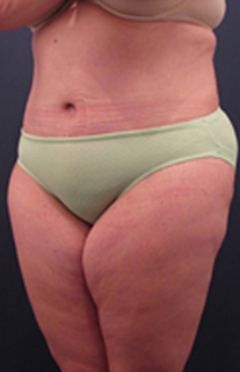 Tummy Tuck Before & After Gallery - Patient 174179745 - Image 4