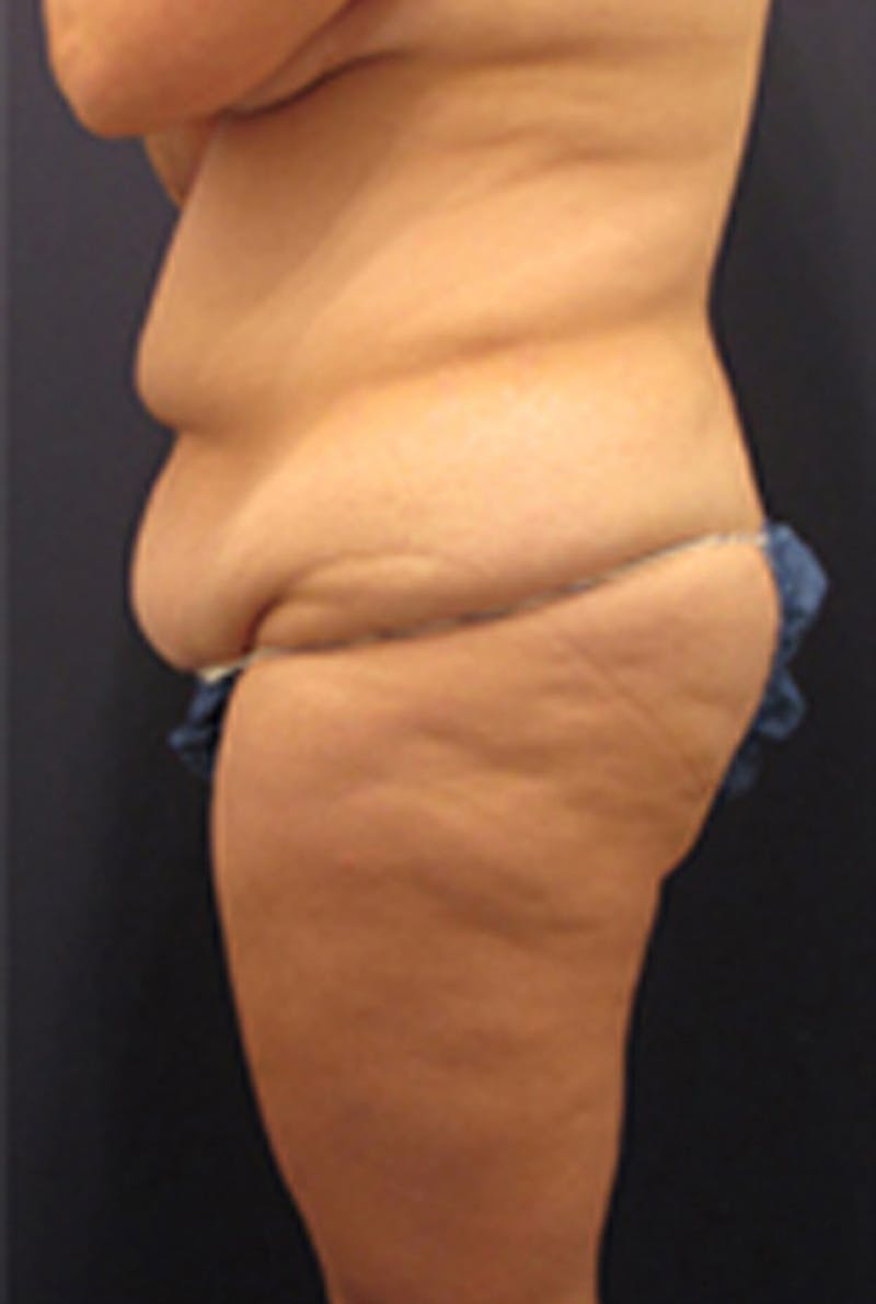 Tummy Tuck Before & After Gallery - Patient 174179745 - Image 5