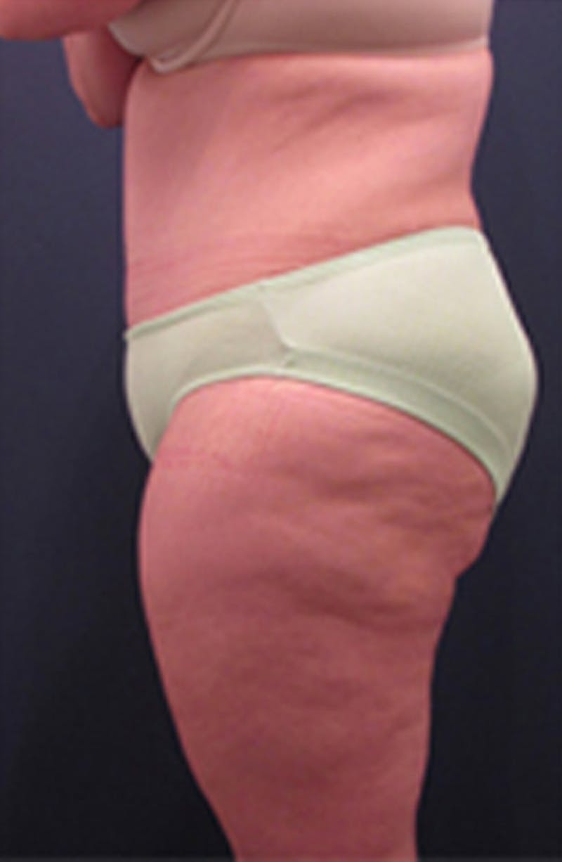 Tummy Tuck Before & After Gallery - Patient 174179745 - Image 6