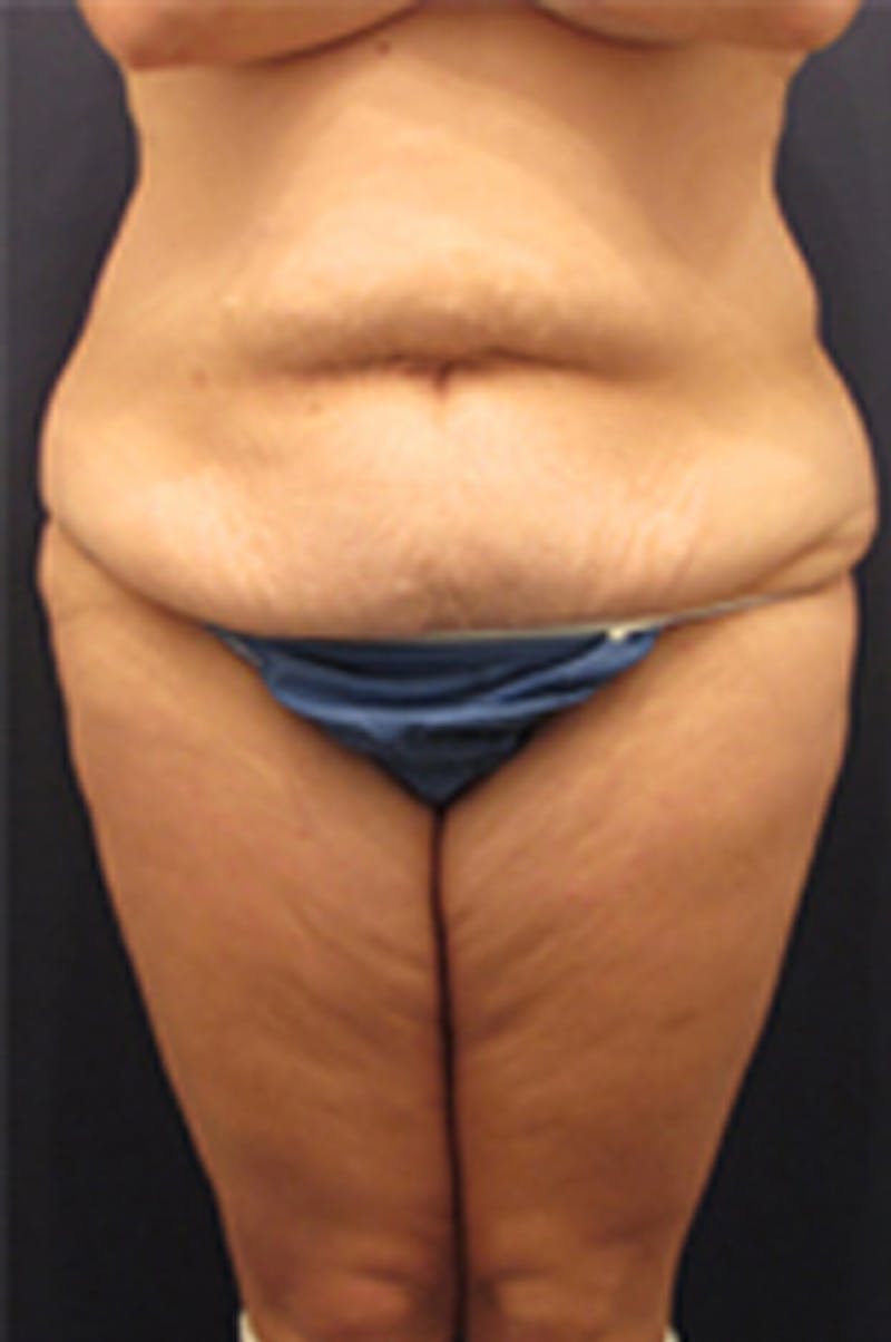 Tummy Tuck Before & After Gallery - Patient 174179745 - Image 1