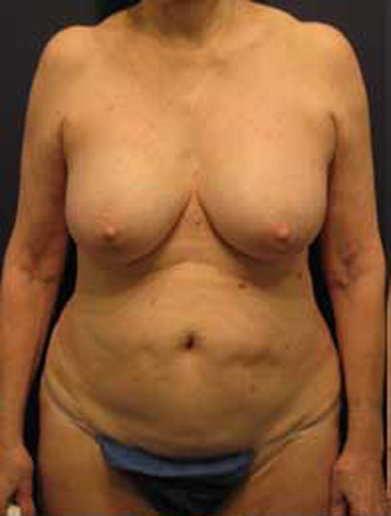 Tummy Tuck Before & After Gallery - Patient 174179746 - Image 1