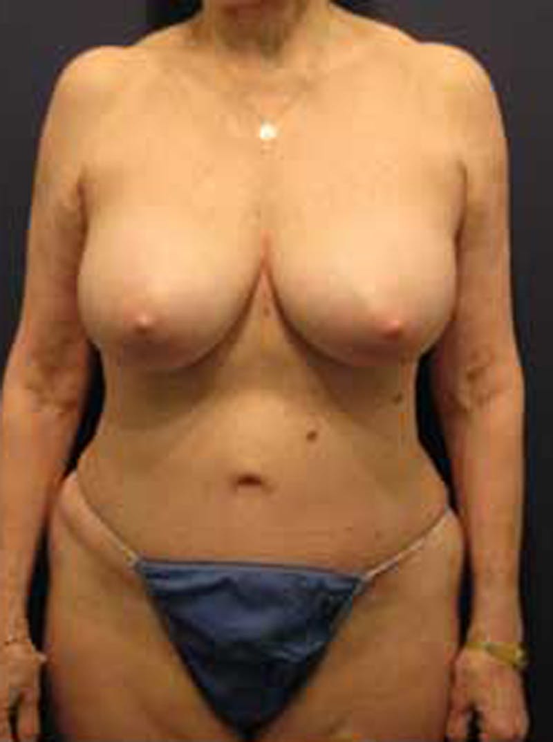 Tummy Tuck Before & After Gallery - Patient 174179746 - Image 2