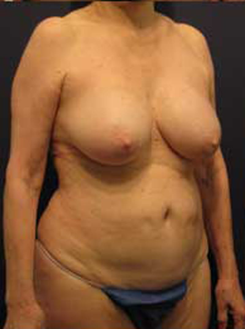 Tummy Tuck Before & After Gallery - Patient 174179746 - Image 3
