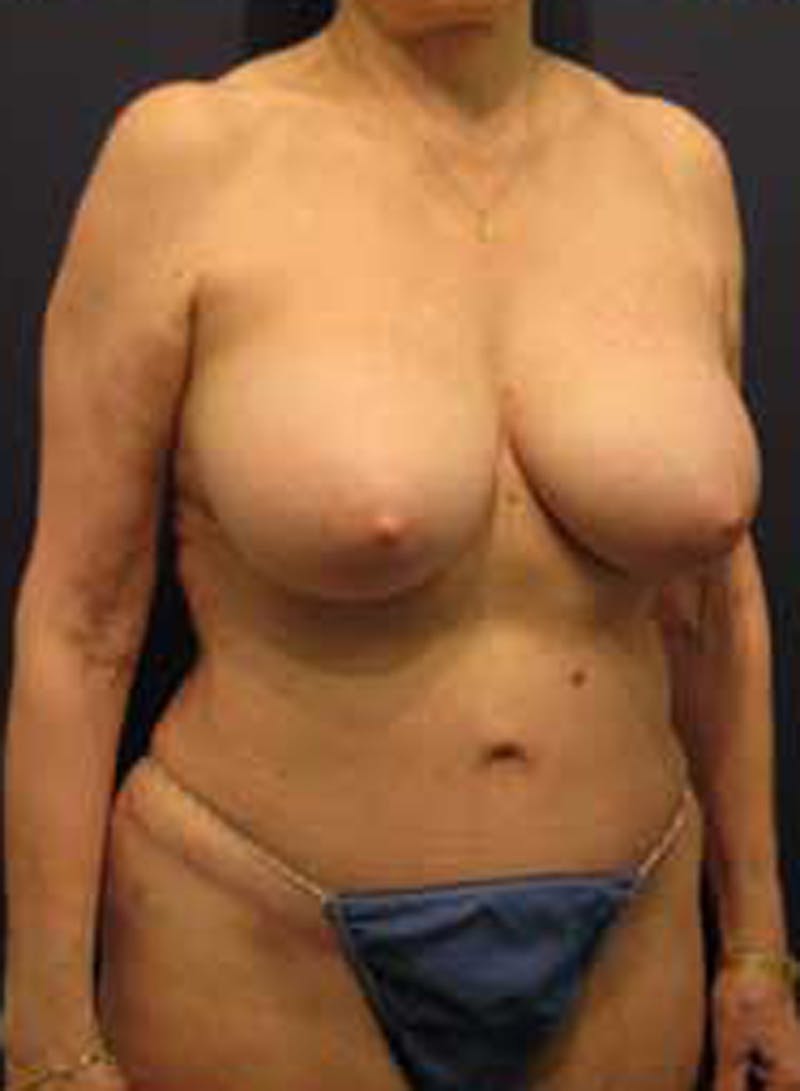 Tummy Tuck Before & After Gallery - Patient 174179746 - Image 4