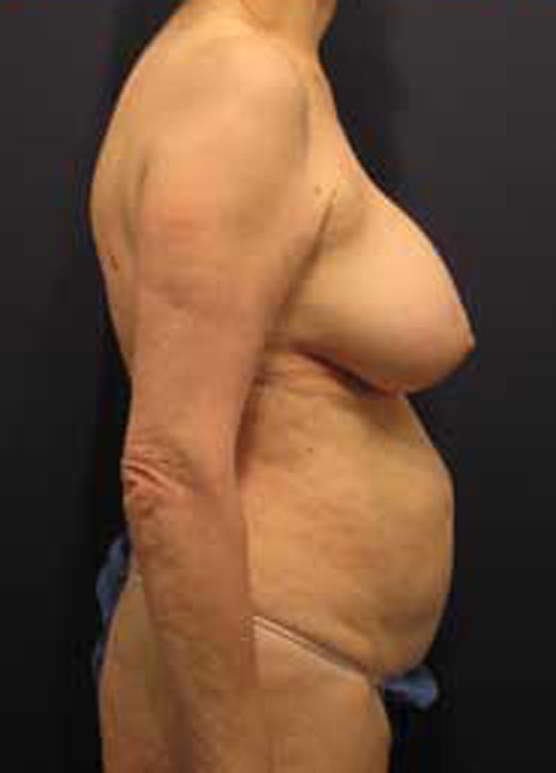 Tummy Tuck Before & After Gallery - Patient 174179746 - Image 5