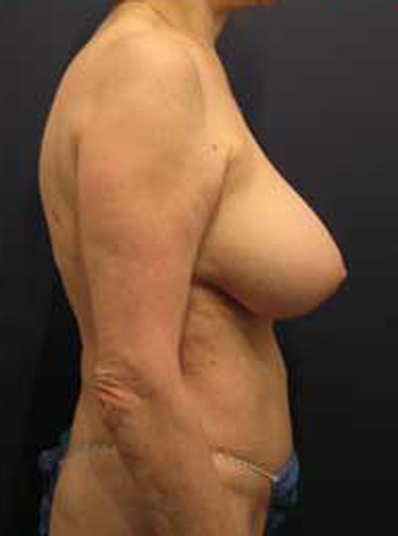 Tummy Tuck Before & After Gallery - Patient 174179746 - Image 6
