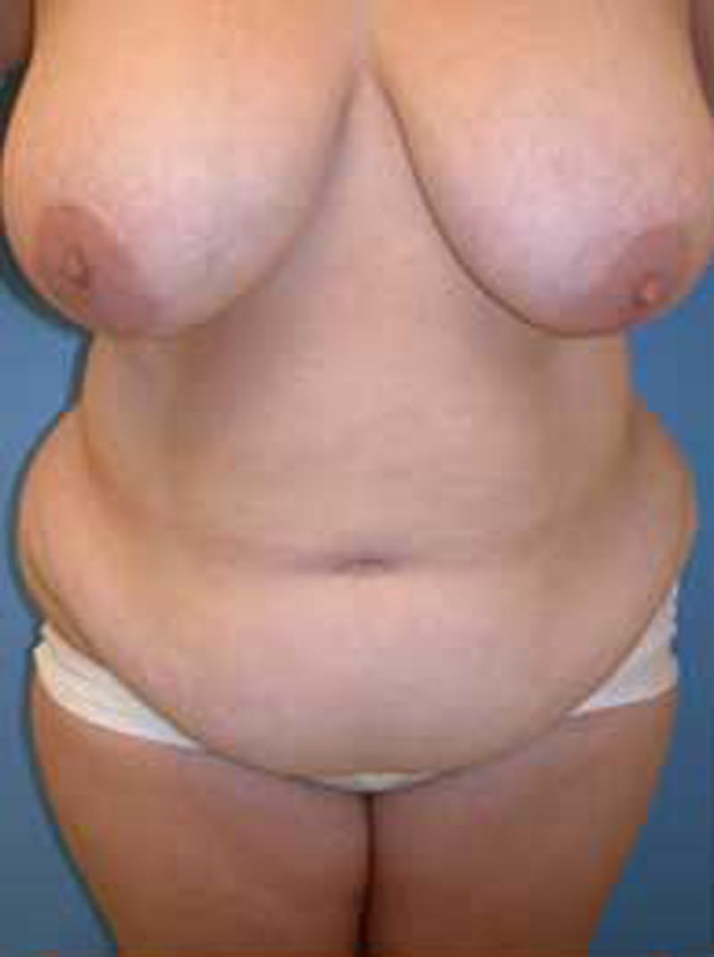 Tummy Tuck Before & After Gallery - Patient 174179747 - Image 1