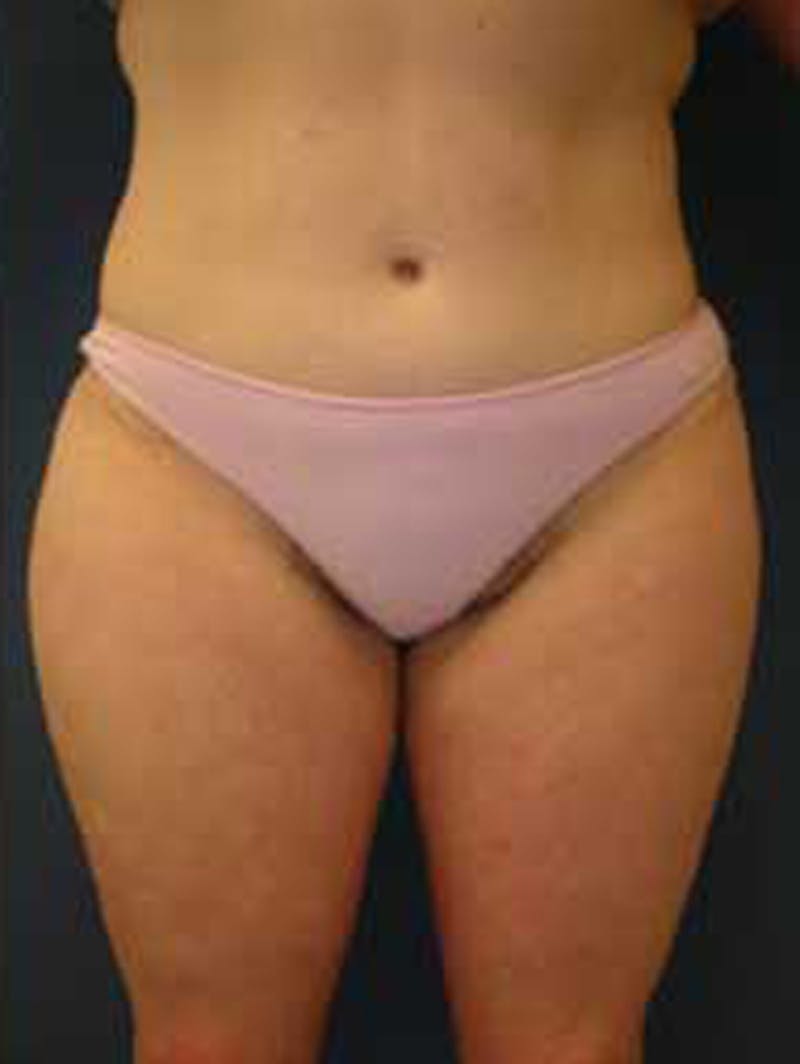 Tummy Tuck Before & After Gallery - Patient 174179747 - Image 2