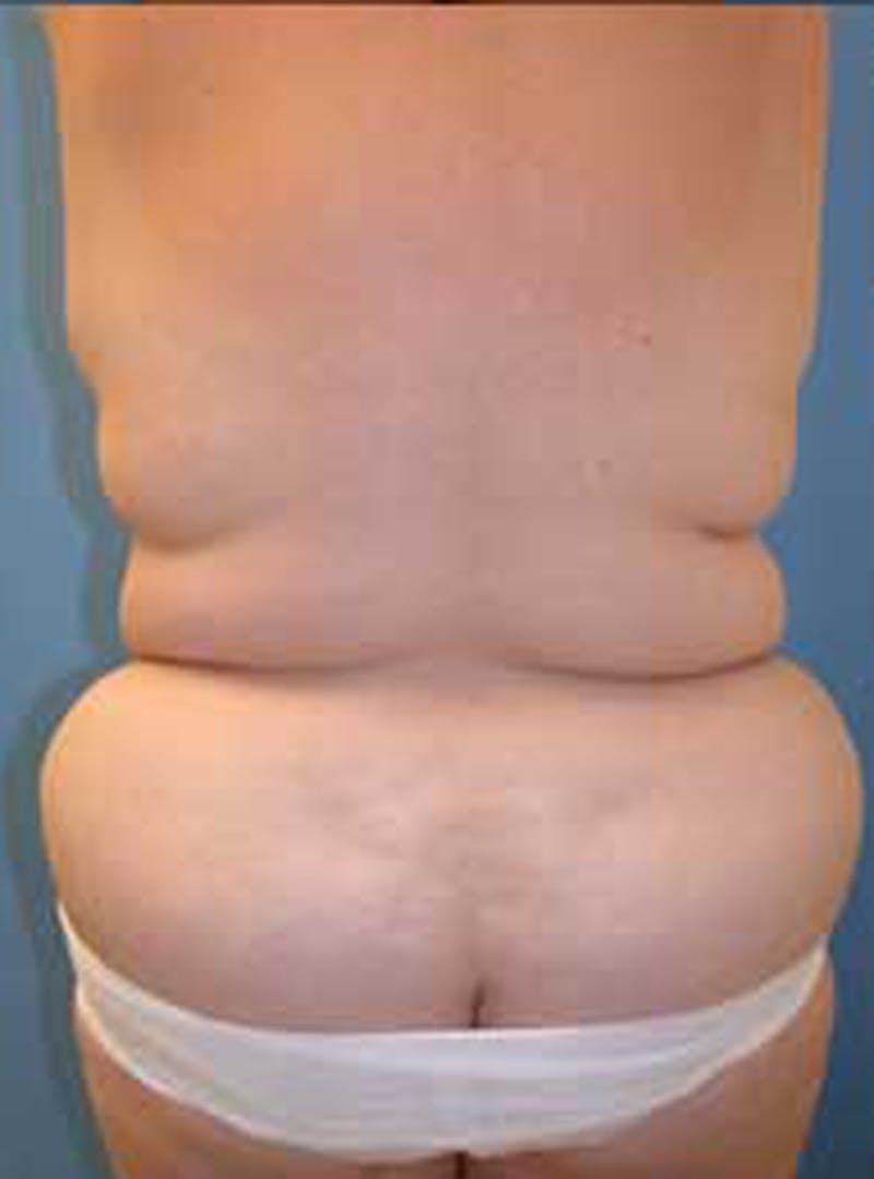 Tummy Tuck Before & After Gallery - Patient 174179747 - Image 3