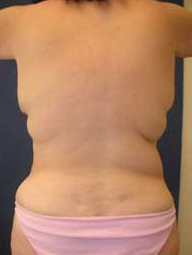 Tummy Tuck Before & After Gallery - Patient 174179747 - Image 4