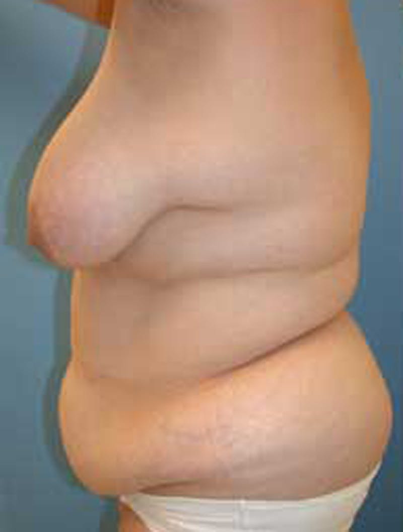 Tummy Tuck Before & After Gallery - Patient 174179747 - Image 5