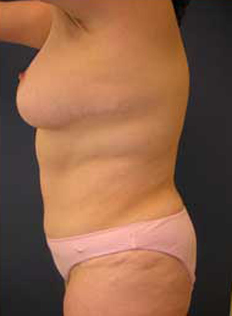 Tummy Tuck Before & After Gallery - Patient 174179747 - Image 6