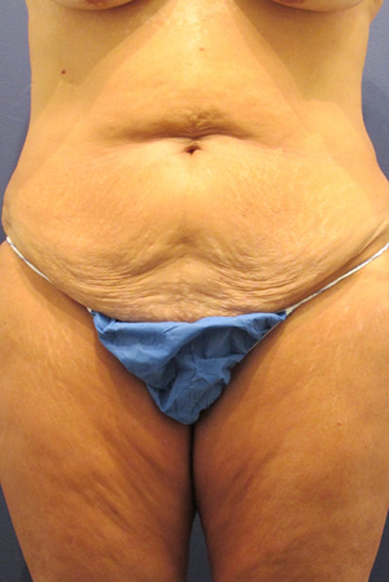 Tummy Tuck Before & After Gallery - Patient 174179750 - Image 1