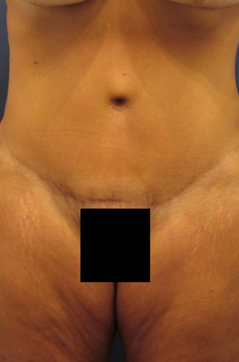 Tummy Tuck Before & After Gallery - Patient 174179750 - Image 2