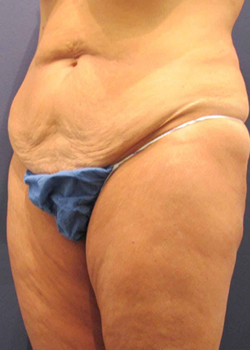 Tummy Tuck Before & After Gallery - Patient 174179750 - Image 3
