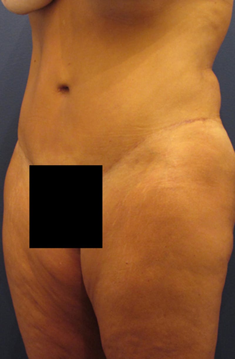 Tummy Tuck Before & After Gallery - Patient 174179750 - Image 4