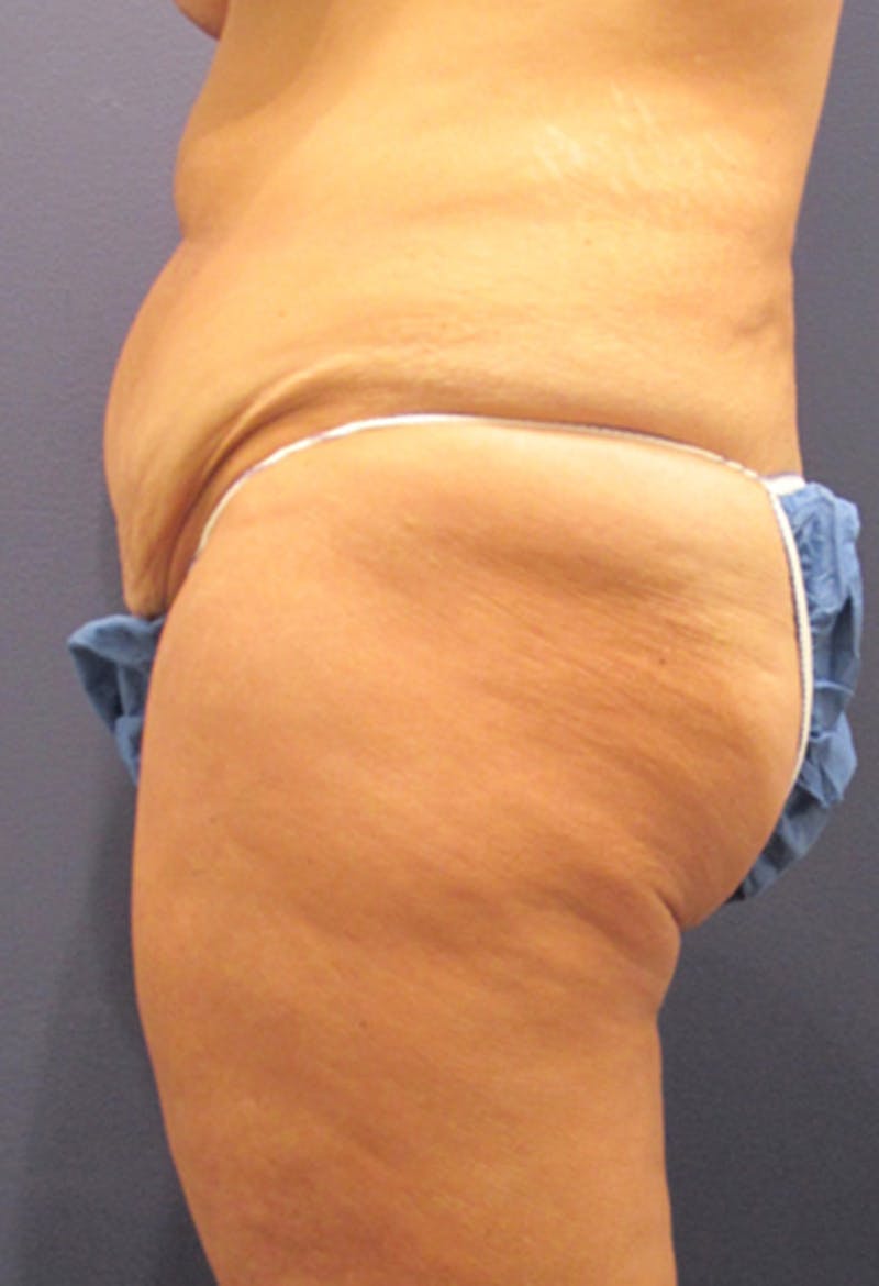 Tummy Tuck Before & After Gallery - Patient 174179750 - Image 5