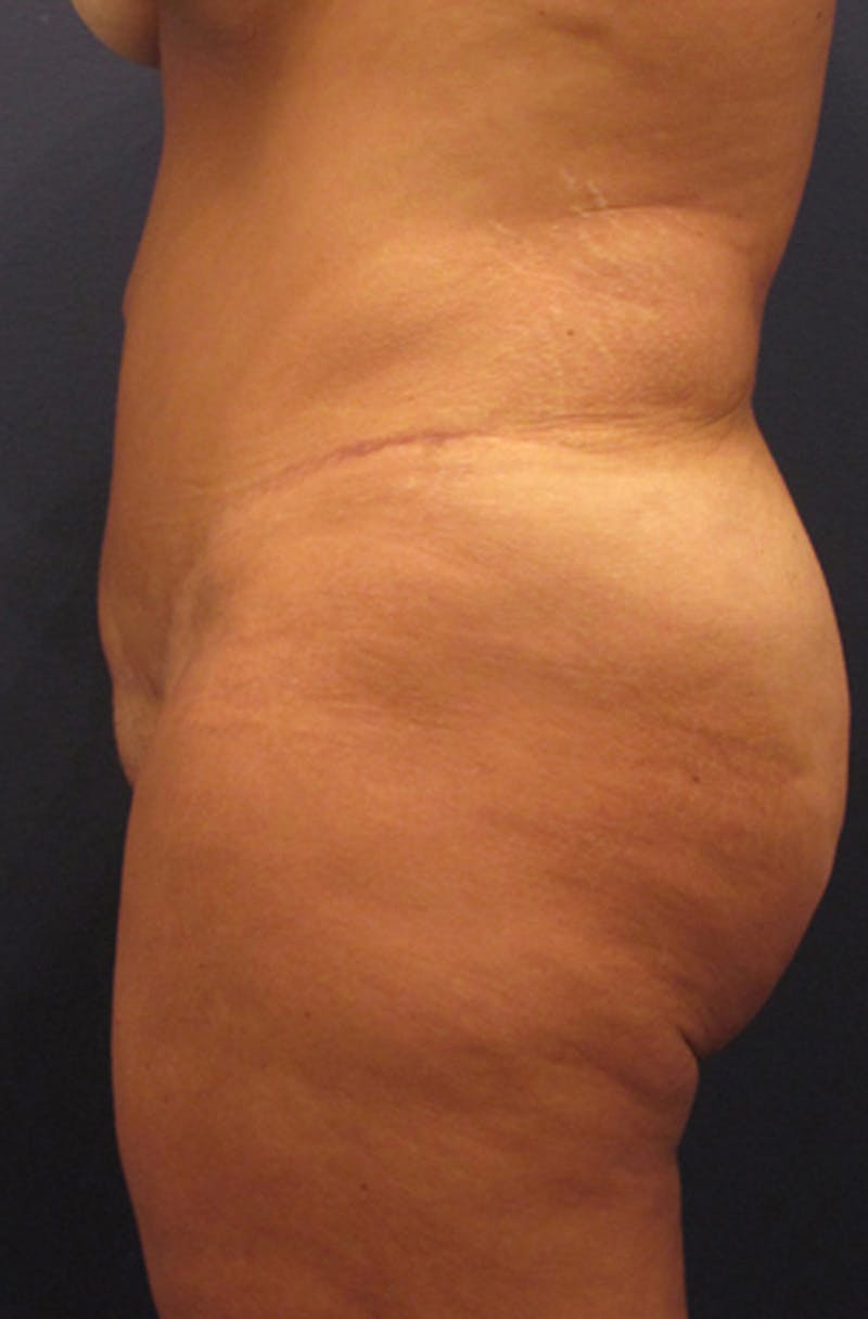 Tummy Tuck Before & After Gallery - Patient 174179750 - Image 6