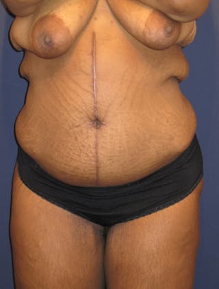 Tummy Tuck Before & After Gallery - Patient 174179752 - Image 2