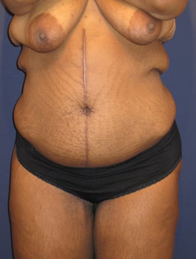 Tummy Tuck Before & After Gallery - Patient 174179752 - Image 2
