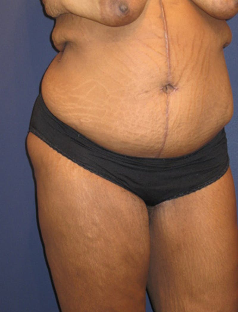 Tummy Tuck Before & After Gallery - Patient 174179752 - Image 4