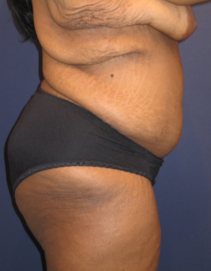 Tummy Tuck Before & After Gallery - Patient 174179752 - Image 6