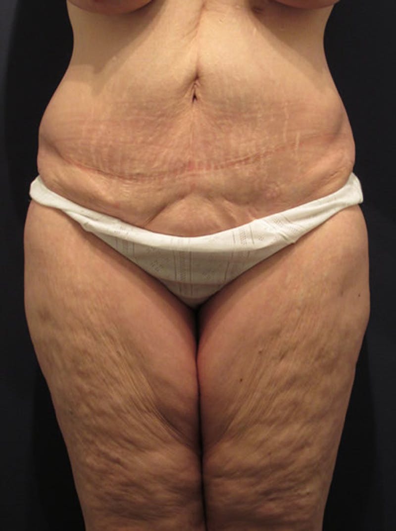 Tummy Tuck Before & After Gallery - Patient 174179758 - Image 1