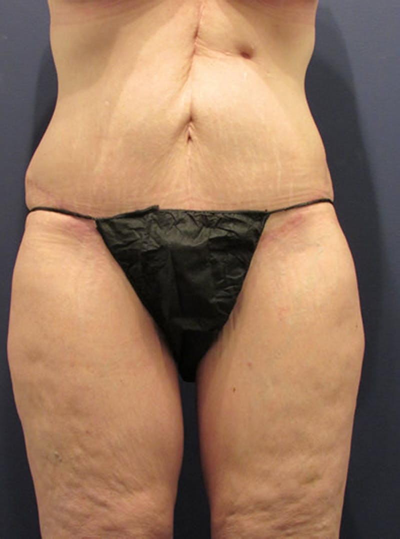 Tummy Tuck Before & After Gallery - Patient 174179758 - Image 2